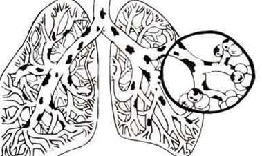 如何有效预防支气管扩张的小妙招